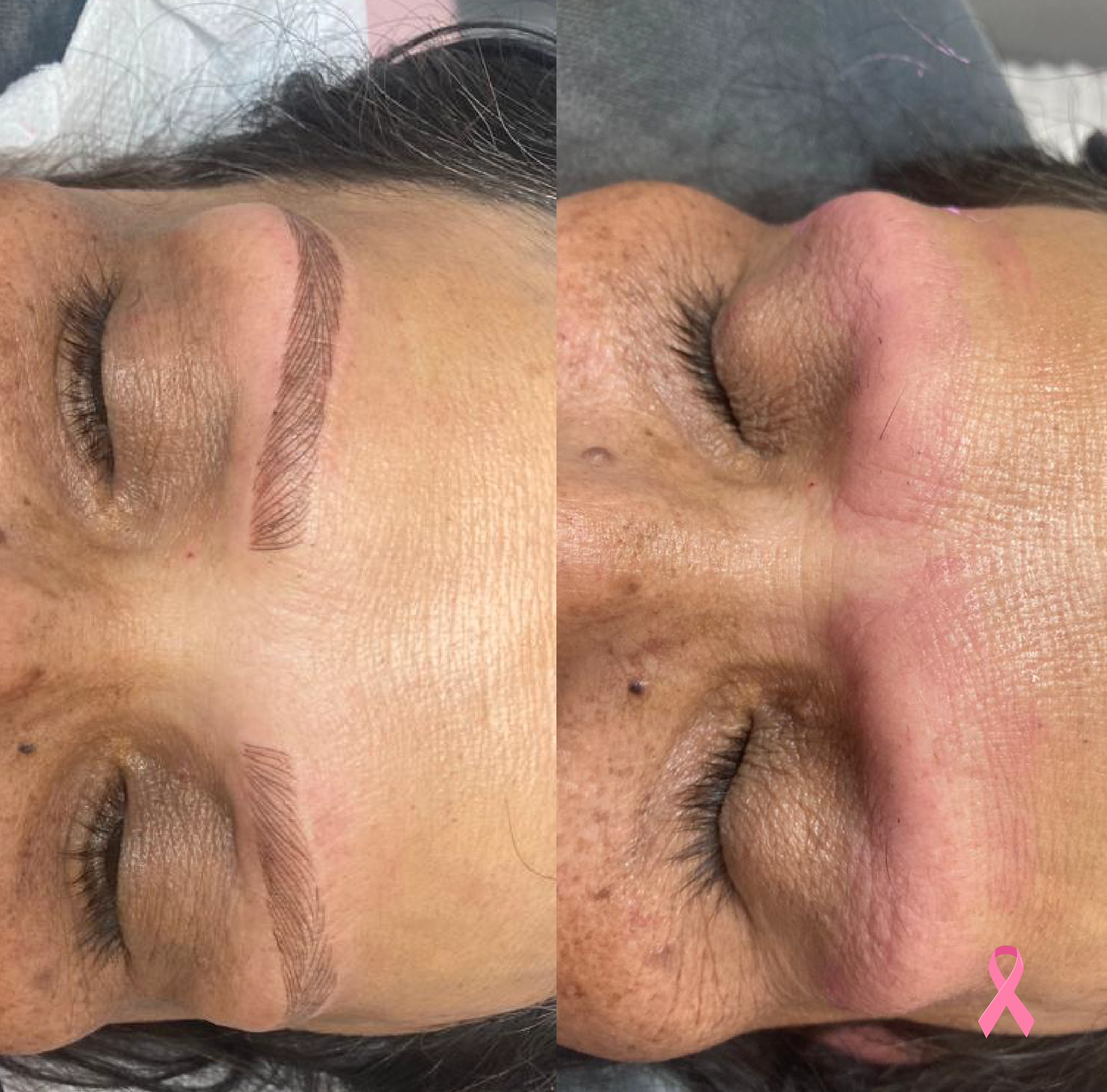 reconstrucción de cejas - oncoestética